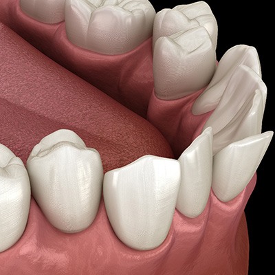 Illustration of crooked teeth
