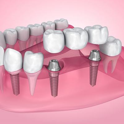 Exploded illustration of dental implants with bridge