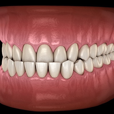 Illustration of an underbite