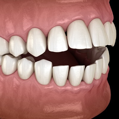 Illustration of an open bite