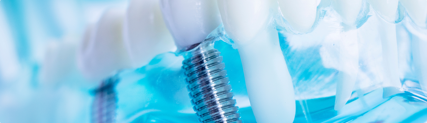 Model of the mouth with two dental implants in Little Elm replacing missing teeth