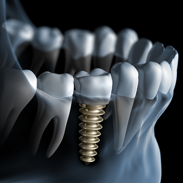 Illustrated x ray of a person with a dental implant replacing a missing lower tooth