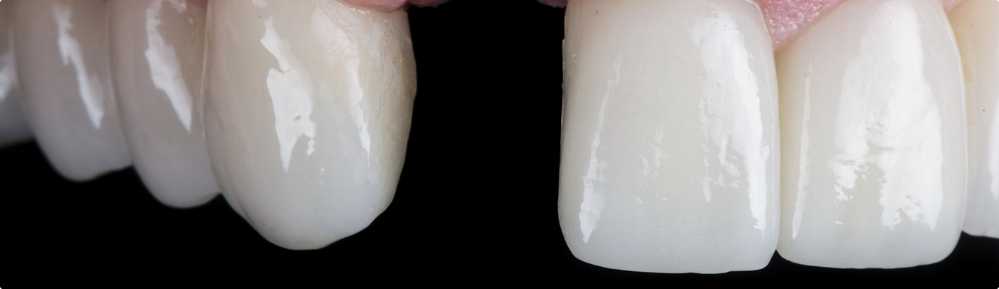 Close up of a mouth with one upper missing tooth