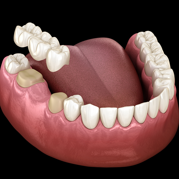 Illustration of a dental bridge replacing a missing tooth