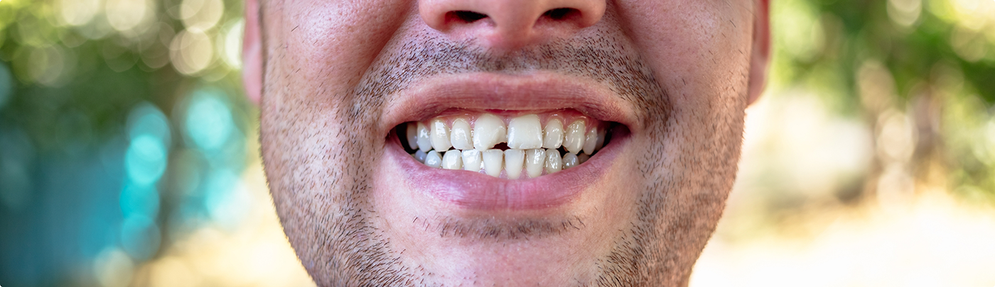 Close up of a man with a chipped tooth before restorative dentistry treatment