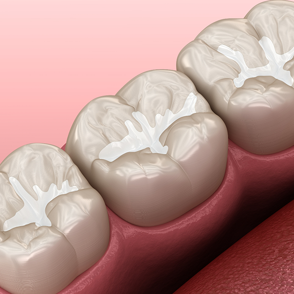 Illustration of a row of teeth with dental sealants