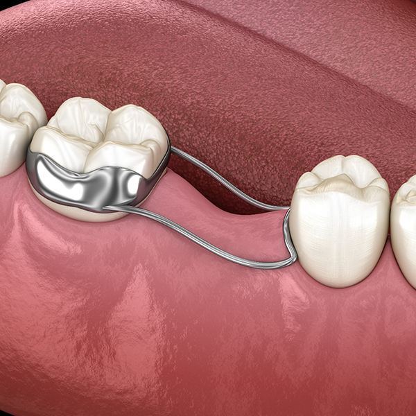 Illustration of a wire device attached to a tooth and keeping the empty space next to it open
