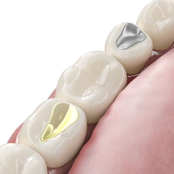 Illustration of a row of teeth with silver, gold, and tooth colored dental crowns and fillings