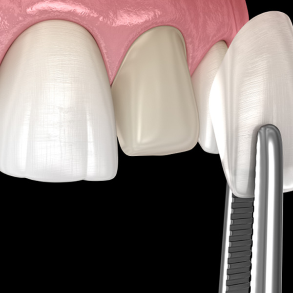 Placing a single veneer on a prepared tooth