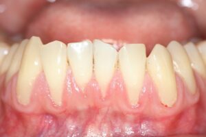 Can Receding Gums Be Fixed