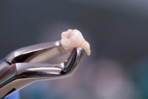 What Is The Tooth Extraction Healing Timeline