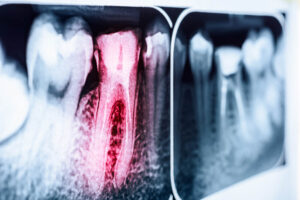 Can A Root Canal Cause A Sinus Infection