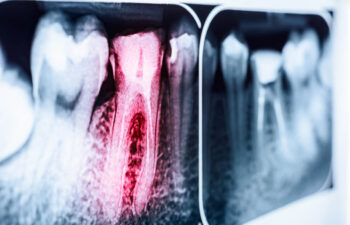 Can A Root Canal Cause A Sinus Infection