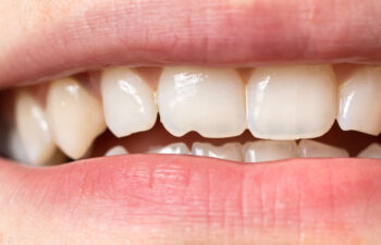 Is a Chipped Tooth a Dental Emergency