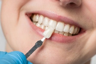 Woman smiling as dentist holds up a dental veneer